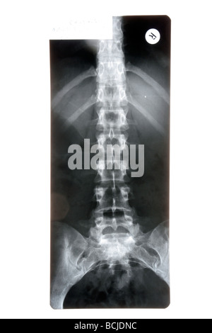 X-RAY film d'abaisser le thorax et le bassin. Banque D'Images