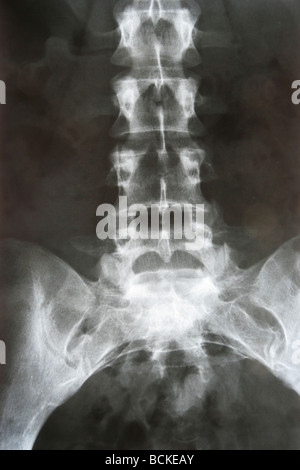 X-RAY film d'abaisser le thorax et le bassin. Banque D'Images