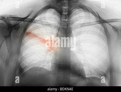 La radiographie du thorax d'un homme de 31 ans montrant une infiltration dans le lobe moyen droit du poumon d'une pneumonie Banque D'Images