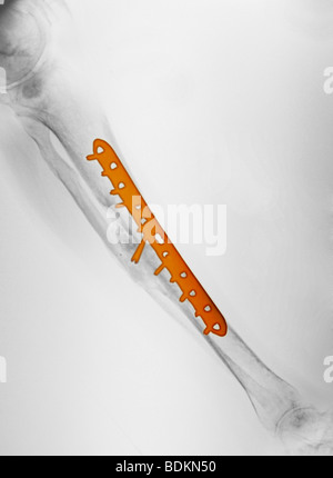 X-ray montrant la réparation chirurgicale du tibia et du péroné d'un vieil homme de 58 ans impliqué dans un accident de moto Banque D'Images