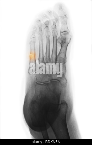 Pied x-ray of a 74 ans, femme, et montrant une fracture du 5e métatarse Banque D'Images