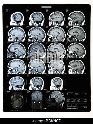 L'IRM ou de radiographies montrant la tête du cerveau et du crâne. Banque D'Images