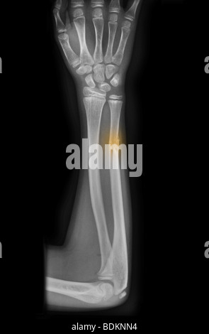 X-ray de l'avant-bras montrant une fracture du cubitus dans un garçon de 10 ans avec l'ostéogenèse imparfaite Banque D'Images