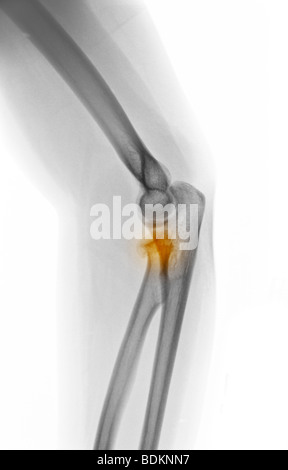 X-ray du coude montrant une fracture de la tête radiale dans 19 ans, femme Banque D'Images