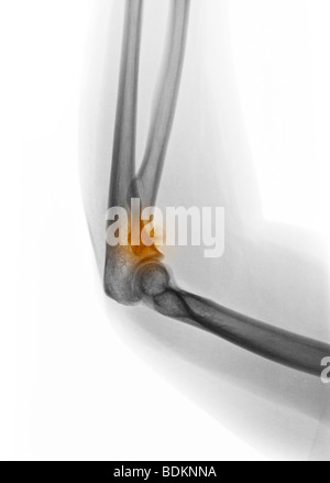 X-ray du coude montrant une fracture de la tête radiale dans 19 ans, femme Banque D'Images