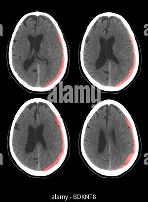 Scanographie du cerveau d'un homme de 73 ans montrent une hémorragie intracrânienne Banque D'Images