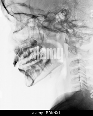 Skull x-ray d'un garçon de 9 ans, normal Banque D'Images