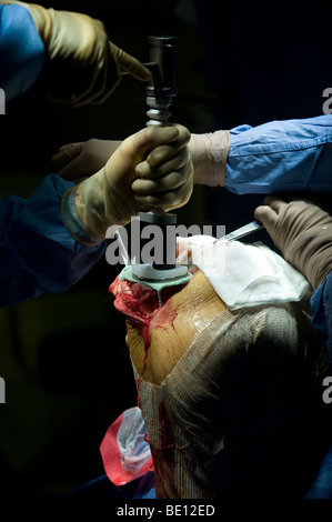 Un patient subit une chirurgie de remplacement du genou dans un hôpital de West Midlands, après un diagnostic de dommages irréparables Banque D'Images