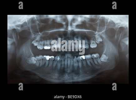 X-Ray de problématique pour l'extraction des dents de sagesse, et plombages Banque D'Images
