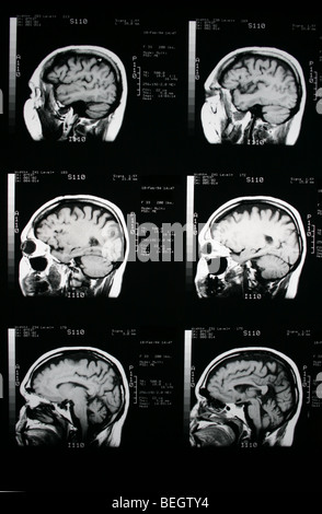 Irm du cerveau du patient avec et sans agent de contraste Banque D'Images