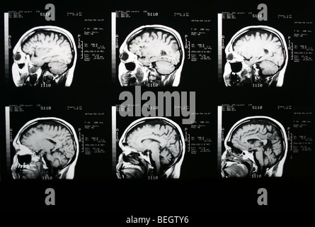 Irm du cerveau du patient avec et sans agent de contraste Banque D'Images