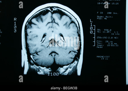 Irm du cerveau du patient avec et sans agent de contraste Banque D'Images