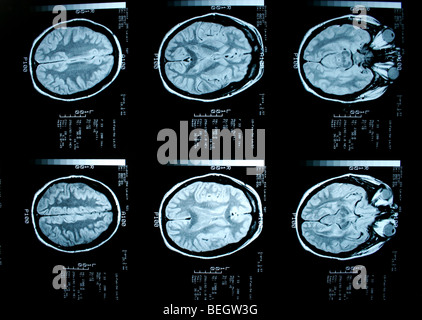 Irm du cerveau du patient avec et sans agent de contraste Banque D'Images