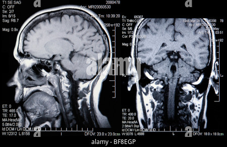 L'Affichage double de l'IRM de la tête et du cerveau Banque D'Images