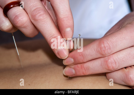 Placer des aiguilles d'acupuncteur en points arrière sur mans retour Banque D'Images