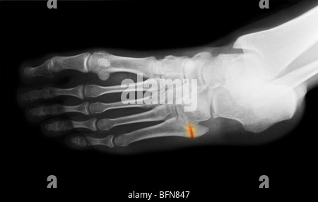 X-ray montrant une fracture à la base du cinquième métatarsien du pied Banque D'Images