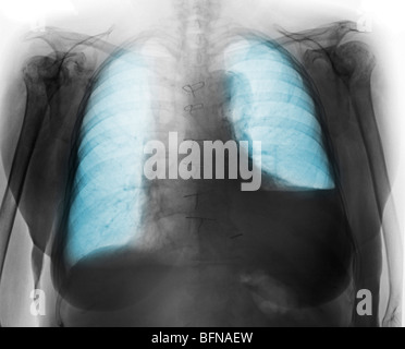 Radiographie d'une vieille femme de 84 ans avec un petit épanchement pleural droit et gauche modérée d'un épanchement pleural. Banque D'Images