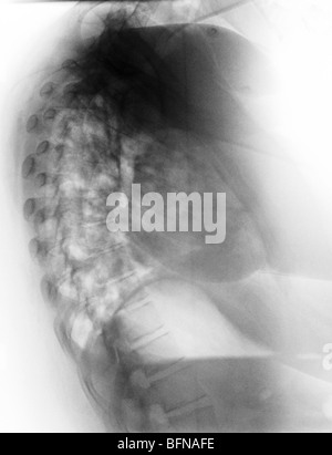 Radiographie pulmonaire anormale montrant une pneumonie en âgée de 27 ans avec la grippe. Banque D'Images