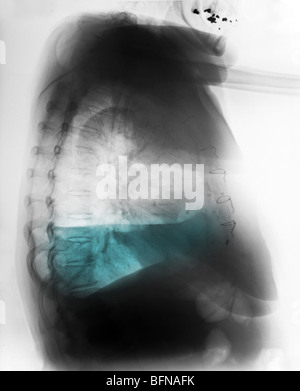 Radiographie d'une vieille femme de 84 ans avec un petit épanchement pleural droit et d'un épanchement pleural gauche modérée Banque D'Images