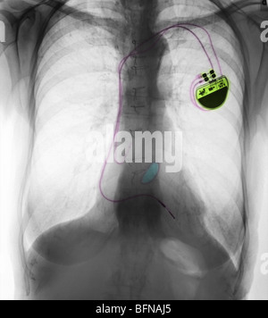 84 ans, femme, et d'un stimulateur cardiaque, remplacement de valve et la MPOC Banque D'Images