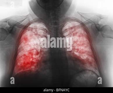 Radiographie pulmonaire anormale montrant une pneumonie en âgée de 27 ans avec la grippe. Banque D'Images