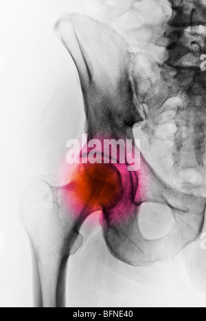 X-ray colorisée d'une hanche normale Banque D'Images