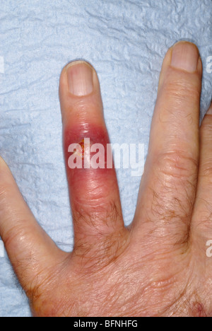Le SARM infection staphylococcique sur l'anneau de doigt d'un homme de 79 ans ayant des antécédents de diabète Banque D'Images