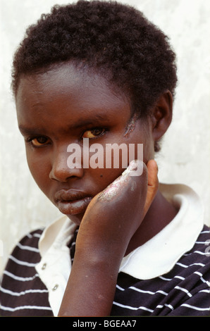 Kyonza, Rwanda, août 1994 ; Joanne D'Arc, Mkannana Kyonza 15, à l'orphelinat, avait ses doigts coupée par mititias Hutu. Banque D'Images