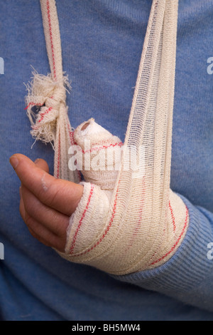 Une personne avec un pouce cassé porte un cast et a leur main dans une écharpe. Banque D'Images