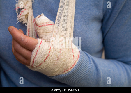 Une personne avec un pouce cassé porte un cast et a leur main dans une écharpe. Banque D'Images