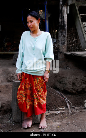 Une Karen femmes souffrant de l'éléphantiasis avec jambe gonflée, camp de réfugiés de Mae la , près de Mae Sot en Thaïlande du nord , Banque D'Images