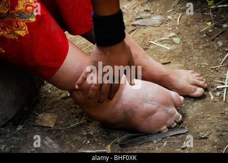 Une Karen femmes souffrant de l'éléphantiasis avec jambe gonflée, camp de réfugiés de Mae la , près de Mae Sot en Thaïlande du nord , Banque D'Images