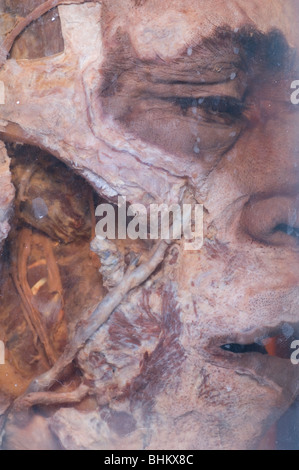 Closeup of a dead man's head conservé dans un bocal de verre Banque D'Images