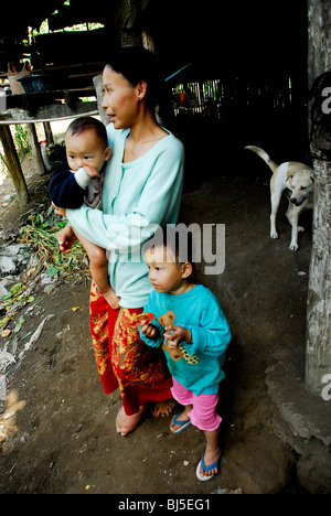 Karen femmes souffrant de l'éléphantiasis avec jambe gonflée, camp de réfugiés de Mae la , près de Mae Sot en Thaïlande du nord , Banque D'Images