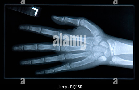 Close-up xray de main. Banque D'Images