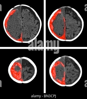 CT scan colorisée montrant un hématome sous (rouge) à un garçon de 6 mois Banque D'Images