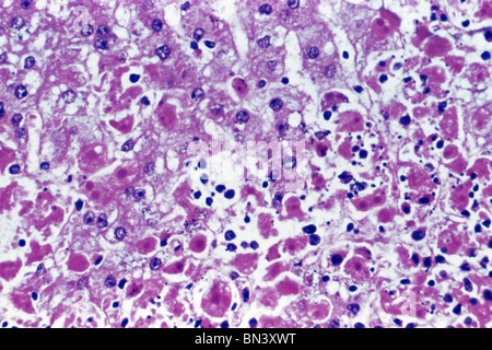 Micrographie de la lumière des hépatocytes (cellules du foie) infectées par le virus Ebola, la cause de la fièvre hémorragique Ebola Banque D'Images