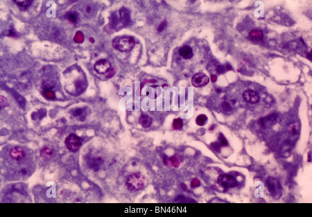 Micrographie de la lumière des hépatocytes (cellules du foie) infectées par le virus Ebola, la cause de la fièvre hémorragique Ebola Banque D'Images