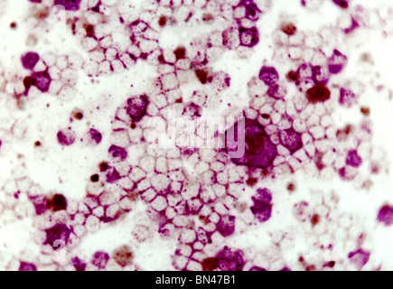 Photomicrographie montrant le virus respiratoire syncytial (VRS) à l'aide technique d'immunofluorescence indirecte Banque D'Images