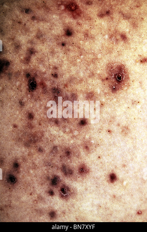 L'acné de la peau. l'image a été un peu poste a traité à le faire paraître plus sévère. Banque D'Images