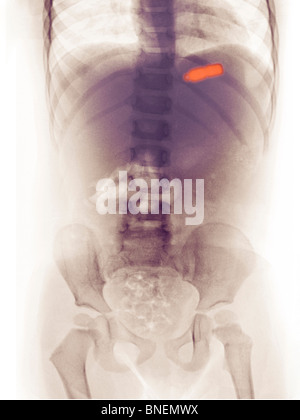 Abdomen x-ray d'une fillette de 2 ans qui l'a avalé un bracelet charm Banque D'Images