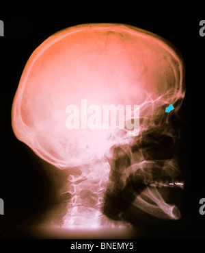 Rayons x du crâne d'une femme d'une balle dans l'oeil avec une arme à plombs. Banque D'Images