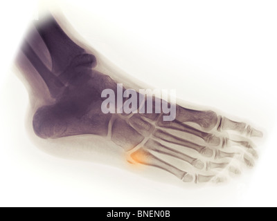 X-ray de la fracture au pied du 5ème métatarsien Banque D'Images