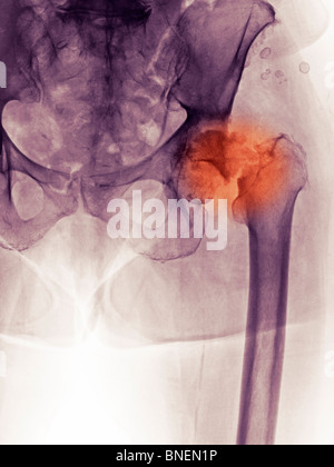 Radiographie d'une fracture de la hanche et la maladie commune dégénérative Banque D'Images