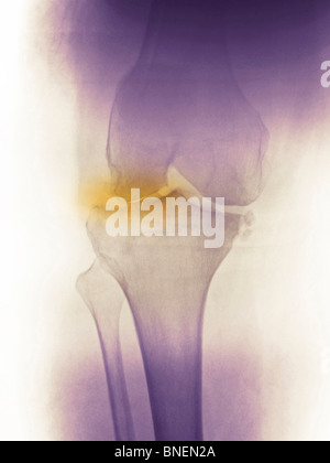 Genou x-ray d'une femme de 60 ans montrant la maladie commune dégénérative Banque D'Images