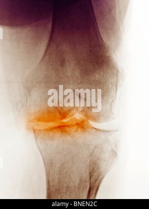 X-ray du genou d'une femme de 83 ans montrant l'arthrite dégénérative. Banque D'Images