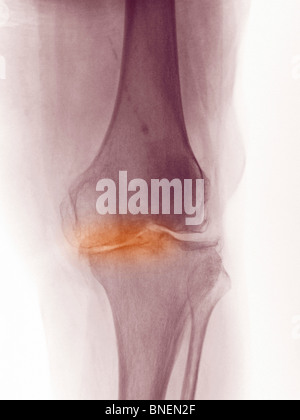 X-ray du genou d'une femme de 83 ans montrant l'arthrite dégénérative. Banque D'Images