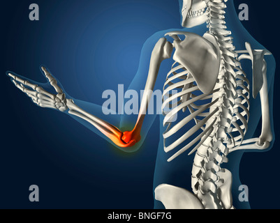 Vue interne du coude rouge avec l'inflammation dans un voir-à travers le bras avec la main et les os de la colonne vertébrale Banque D'Images