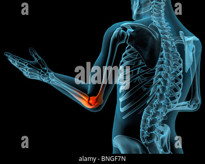 Vue interne du coude avec inflammation rouge dans un voir-à travers le bras avec la main et les os de la colonne vertébrale Banque D'Images