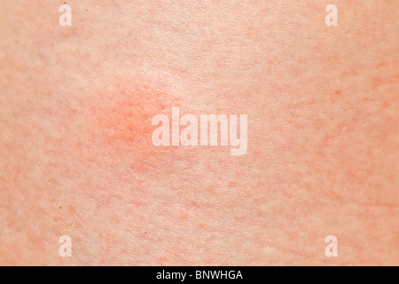 Grand bouton de moustique sur la peau femme Banque D'Images